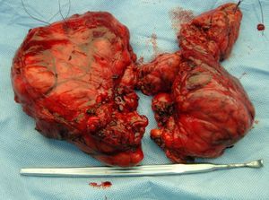 A surgical specimen of total thyroidectomy. A large thyroid gland, in particular its right lobe.