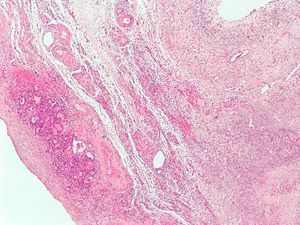 Histological image of struma ovarii in the right ovary.