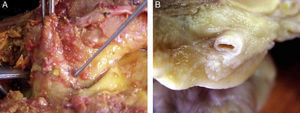 Location of epicardial adipose tissue. (A) The close anatomical relation between epicardial fat and the myocardium is seen. (B) Epicardial adipose tissue around one coronary artery. Note the absence of fascia or similar tissues separating epicardial adipose tissue from these structures.