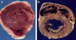 (A) The heart of a 48-year-old obese patient with type 2 diabetes who died from acute myocardial infarction. (B) The heart of a 45-year-old patient with no risk factors who died from violent causes. Note the great thickness of epicardial adipose tissue in patient A as compared to patient B.