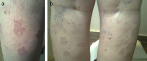 a and b. Granuloma annulare.