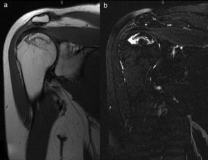 1.5T MRI of the right shoulder. Coronal proton density-weighted (1.a) and fat-saturated proton density-weighted (1.b) series were performed. A geographical lesion reaching the cortical surface with a pathognomonic signet ring sign is seen as a circumscribed subchondral hyposignal outlining the osteonecrosis and with a hyperintense halo inside, which is evident with fat saturation.