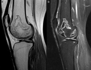 1.5T MRI of the left knee. A sagittal proton density sequence (2.a) and STIR are shown. Two lesions with characteristics similar to that described in Image 1, consistent with osteonecrosis and coming into contact with the anterior and posterior condylar cortical surface are shown.