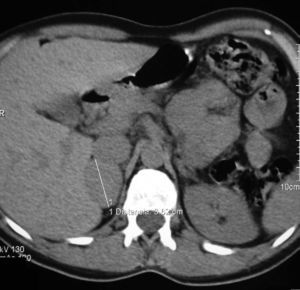 Right adrenal nodule, 3.6cm in size (case 1).