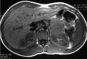Heterogeneous left adrenal mass, 4cm in size (case 2).