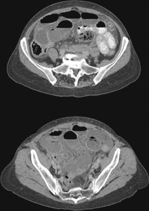 Abdominal CT scan after administration of oral and IV contrast showing a dilatation of the small bowel loops from the jejunum to the ileum except for the distal 20–30cm, where a change in size with no identifiable cause is seen.
