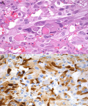 (A) Hematoxylin and eosin staining showing alveolar (predominant) and trabecular patterns with no evidence of confluent tumor necrosis, cytological atypia, vascular invasion, or extracapsular extension. (B) Immunohistochemistry positive for ACTH.