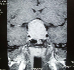 Magnetic resonance imaging scan with gadolinium contrast. T1-weighted coronal section showing a pituitary macroadenoma with suprasellar extension and optic chiasm compression.