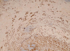 Positivity of tumor nests with the immunohistochemical technique for keratins AE1/AE3 (HE×20).