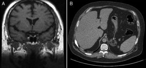 (A) Pituitary MRI: left paramedial hypointense nodular image 2mm in size (arrow) in the sequence without contrast acquired in the coronal plane. (B) Abdominal CT: left adrenal nodule 4.8cm in longest axis, with fat density component, suggesting myelolipoma (arrow).