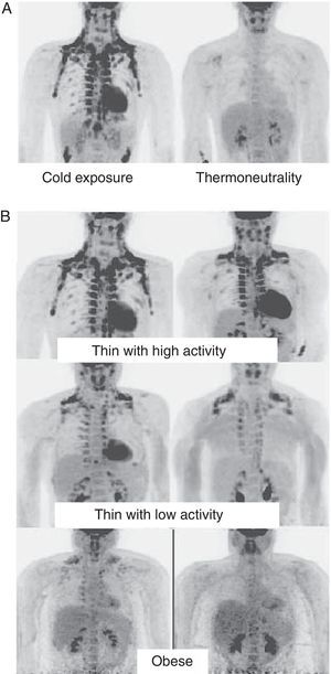 WAT distribution and activity in humans detected by positron emission tomography (PET) with 18F-FDG. (A) Increased TAM activity in a thin individual exposed to low temperature (16°C) or under thermoneutral conditions. (B) TAM activity in thin and obese individuals exposed to low temperature (16°C).
