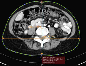 Evaluation of the waist circumference on a CT image, using both a line to approximate the skin contour and calculating the anterior---posterior and transverse abdominal diameters.