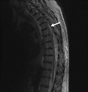 MRI of thoracic spine: epidural abscess in T5–T11 with medullary compression.