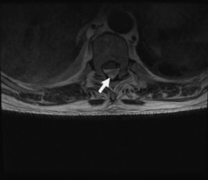 MRI axial section: lumbar spine T5–T11.