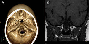 (A) Three-dimensional computed tomography showing bone defect at the base. (B) Magnetic resonance imaging. T1-weighted coronal section showing cystic mass extending to the nasopharynx through bone defect.