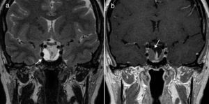 Coronal T2-weighted spin-echo (a) and T1-weighted spin-echo (b) MRI sequences after intravenous administration of gadolinium. (a) A cystic lesion occupying the space of the sella turcica (arrow). (b) The same lesion appears well defined and hypointense in the pituitary gland, surrounded by a thin linear uptake (arrow).