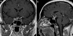 Coronal (a) and sagittal (b) T1-weighted MRI images after intravenous administration of gadolinium. (a) Two cystic lesions in the pituitary gland with peripheral ring-shaped enhancement (arrow). (b) Pituitary stalk also appears thickened and with peripheral enhancement (arrow).