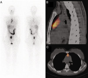 Post-therapy I-131 WBS shows intense diffuse anterior mediastinum uptake (A). Chest SPECT/CT (Sagittal plane) shows intense uptake in thymus gland. (B). Chest SPECT/CT (transversal plane) intense uptake in the thymus (C).
