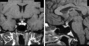 Pituitary stalk thickening in a patient with Langerhans cell histiocytosis.