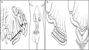 (A) Ileal conduit. (B) Orthotopic ileal neobladder.