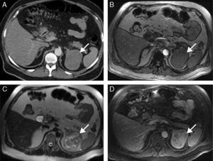 Axial CT and MRI sections centered on the adrenal region. (A) CT with intravenous contrast: hypodense, well-circumscribed left adrenal mass. (B–D) MRI images: in T1 sequences (B), the lesion is isointense on out-of-phase; in T2 sequences (C) it is heterogeneous with hyperintense areas; and in T1 sequences with intravenous gadolinium (D), the lesion shows progressive gadolinium uptake.