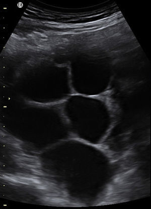 Ovarian ultrasonography at 14 weeks. Multiloculated “spoke-wheel” formation that mimics a hyperstimulated ovary, consistent with theca-lutein cysts.