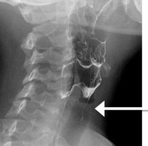 Barium X-ray examination showing a fistula tract from the hypopharynx to the thyroid gland.