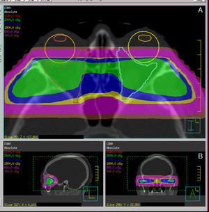 Sample dosimetric planning and distributions with conventional 3D RT (A) (2 lateral and opposed fields) and VMAT (B) (volumetric modulated arc therapy). Increased conformation of the retrobulbar area is seen with VMAT as compared to the conventional technique.