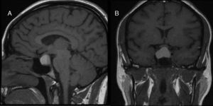 (A) T1-weighted sagittal MRI image showing a sellar lesion with suprasellar extension with a fluid-fluid level suggesting bleeding in different evolutionary stages. (B) T1-weighted coronal MRI image showing a markedly hyperintense sellar lesion with suprasellar extension related to bleeding in contact with the optic chiasm.