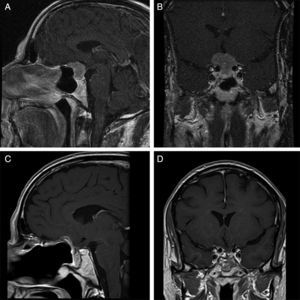 Preoperative magnetic resonance showing an apparently single sellar lesion with suprasellar extension to the tuberculum sellae and planum sphenoidale: (A) sagittal gadolinium enhanced T1-weighted image and (B) coronal gadolinium-enhanced T1-weighted image. Postoperative study with the same sagittal (C) and coronal (D) sequences shows a complete resection and sealing of the skull base with a nasoseptal flap.