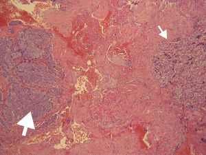 Photomicrograph of a section of the lesion that shows two different neoplastic tissues in contact (hematoxylin and eosin, 100×): clusters of densely packed cells of a meningothelial meningioma (big arrow) and a distorted acinar pattern of chromophobe cells corresponding to a pituitary adenoma (small arrow).