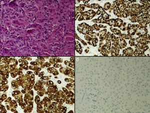 (a) Proliferation of tumor cells with large eosinophlic and granular cytoplasms, with a diffuse growth pattern, showing nuclear pleomorphism. (b–d) Tumor cell cytoplasm shows strong, diffuse staining with melan-A and alpha-inhibin, but no staining for chromogranin.