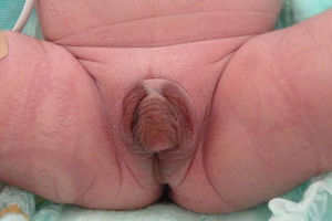 Ambiguous genitalia at birth.