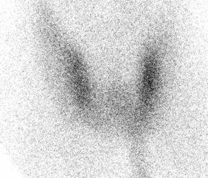 Thyroid scan with 99mTc: low quality examination due to inadequate thyroid uptake of the tracer. The condition may be attributed to the repeated application of povidone iodine to foot lesions.