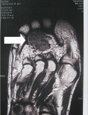 A phosphaturic mesenchymal tumour located in the sole of the foot. MRI shows a heterogeneous lesion of low intensity and irregular margins approximately 2cm×3cm in size.