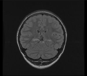 Coronal FLAIR section with increased bilateral medial temporal signal.