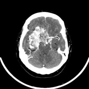 CT scan of the head with contrast. Sagittal section. Day 30 of hospital stay, 20 days after partial lesion resection through a transsphenoidal approach.