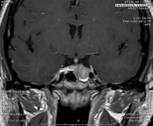 Coronal MRI image, a post-gadolinium T1 SE sequence, showing a 15×16×11mm sellar lesion corresponding to case 2.
