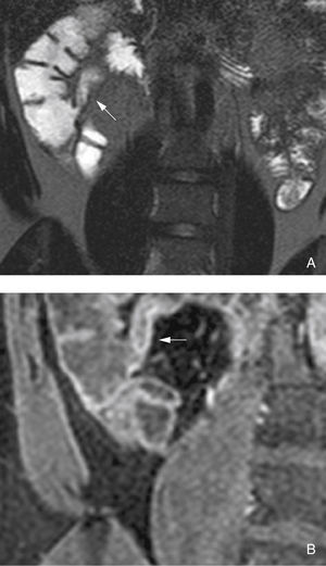 Anastomosis with no signs of recurrence (Rutgeerts i0). (A) Coronal SS-T2-TSE image shows no wall thickening and no hyperintense signal at the anastomosis site (arrow). (B) Coronal fat-suppressed postgadolinium T1-EG image shows normal enhancement (<70% in comparison with the study without contrast, not shown).