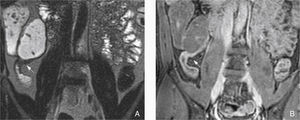 High-grade recurrence (Rutgeerts i3) confined to the anastomosis (arrows). (A) Coronal SS-T2-TSE sequence shows wall thickening >3mm. (B) Coronal fat-suppressed postgadolinium T1-EG image shows enhancement of the thickened wall.