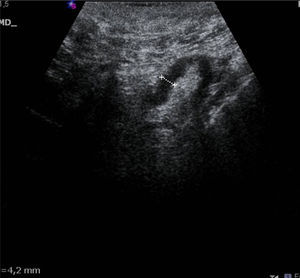 Lymph node with cortical >3mm. CNB: micrometastasis.