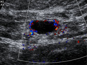 Lymph node with NHCVF and metastasis of IDC.