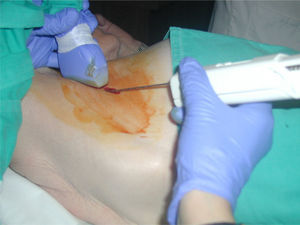 US-guided CNB. Freehand technique.