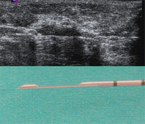 14-Gauge core needle: open specimen collection trough.