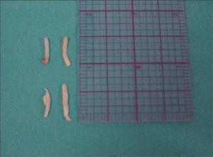 CNB of axillary nodes: specimens.