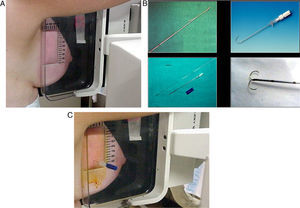 Preoperative localization for biopsy of a non-palpable lesion. (A) Fenestrated compression plate with radiopaque alphanumeric grid. (B) Types of needles with localizing guide wires (“hook wires”). (C) Harpoon insertion with fenestrated compression plate.
