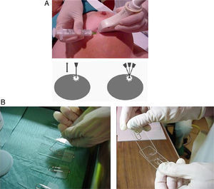 Fine needle aspiration (FNA). (A) Free-hands technique. Aspiration is performed by withdrawing the needle and pushing it back in a number of times, while maintaining aspiration in all planes. (B) Material spreading.