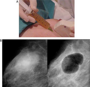 Fine needle aspiration (FNA) puncture. Pneumocystography. (A) Drainage of breast cyst. No cytologic examination is required. (B) Pneumocystography: after liquid aspiration, the cavity is visualised through air injection.