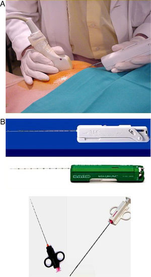 Ultrasound-guided core needle biopsy (CNB). (A) Free-hands technique using an automated device with 14G trucut needle. (B) Devices for CNB: automated and semi-automated devices.