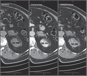 Adrenal adenoma. A 72-year-old patient with an incidentally discovered adrenal nodule in the left adrenal gland that has an attenuation of 23HU on the unenhanced CT study; however, the absolute washout is 69%, which is compatible with an adenoma.